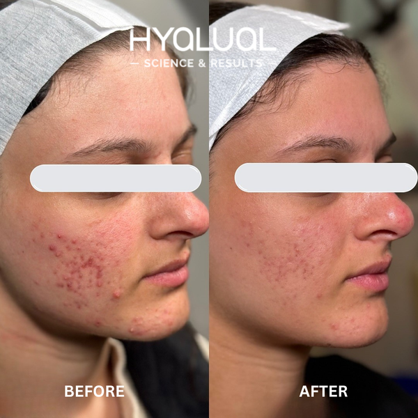Hyalual Clarifying Peel (50ml)