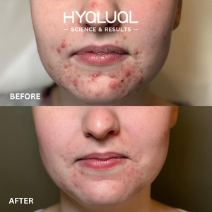 Hyalual Clarifying Peel (50ml)