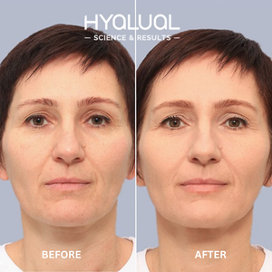 Hyalual Advanced Resurfacing Peel (50ml)