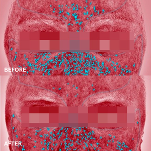 Hyalual Advanced Resurfacing Peel (50ml)