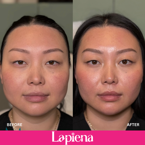 Lapiena Sub-Q (with Lidocane)