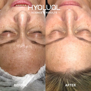 Hyalual Brightening Peel (50ml)