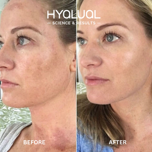 Hyalual Brightening Peel (50ml)
