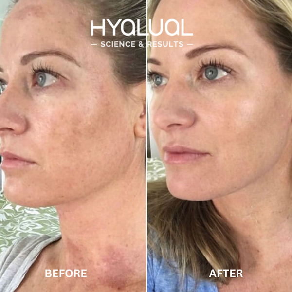Hyalual Brightening Peel (50ml)